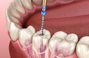 Common Signs You Need A Root Canal Treatment