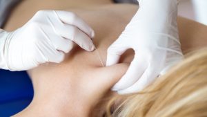 An In-Depth Guide to Dry Needling and Trigger Point Injections