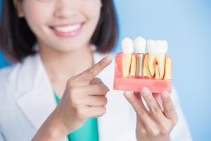 The Benefits of Dental Implants – Why They’re Worth the Investment